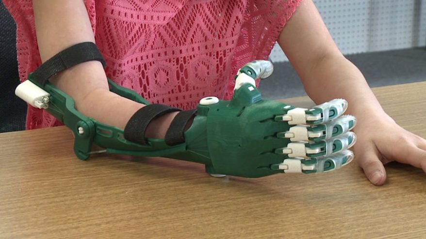 3d printed prosthetics